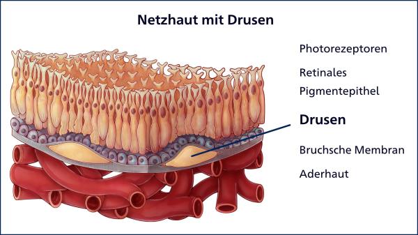 Grafische Darstellung einer Netzhaut mit Drusen